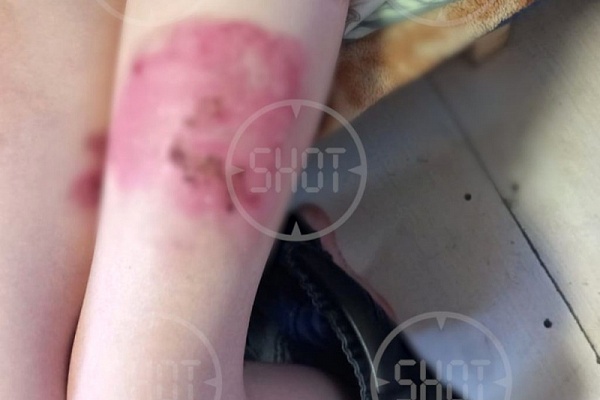Раны на теле одного из детей. Фото из телеграм-канала SHOT
