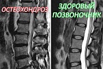 Чем отличается остеохондроз от процесса старения позвоночника?